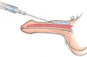 Opasna metoda povećanja penisa pomoću injekcija vazelina